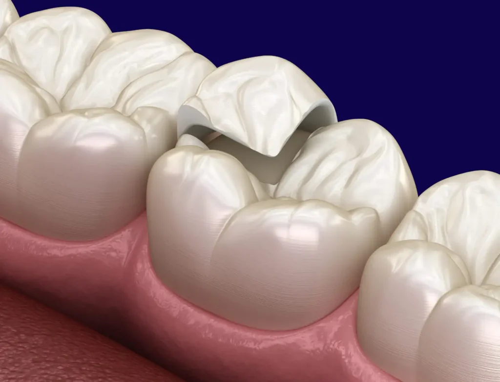 Dental Overlays in Torquay