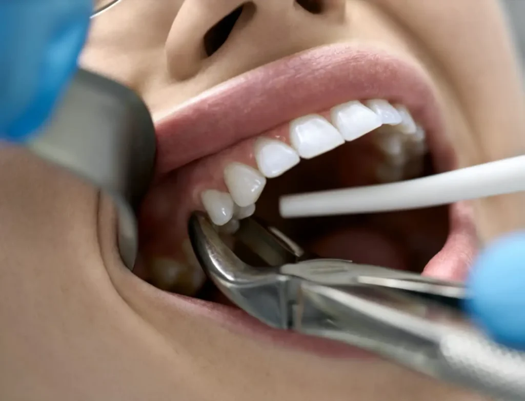 tooth extractions in Torquay